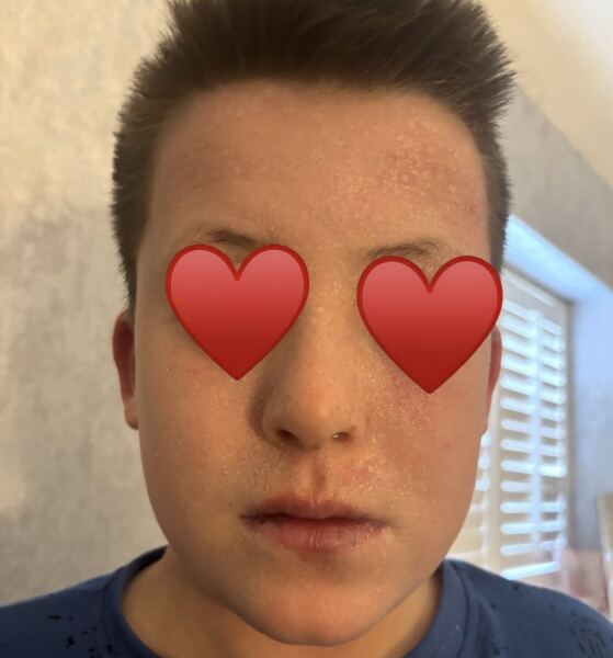 My heart breaks for my son with terrible eczema.