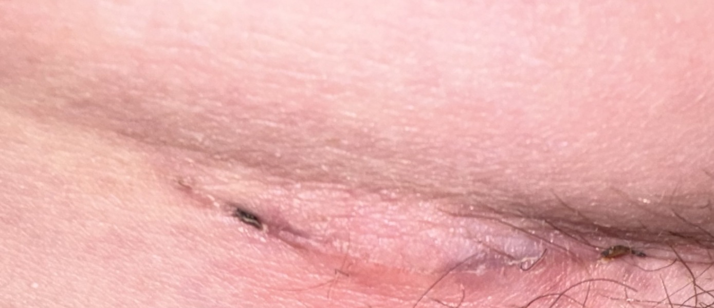Does this csection wound look infected?