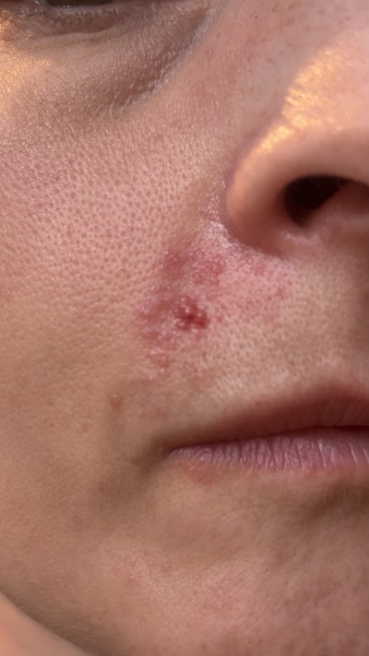 Shingles- on face??