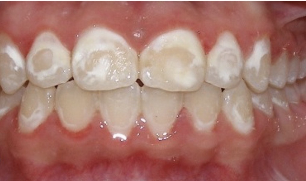 To ask for teeth cleaning advice...?