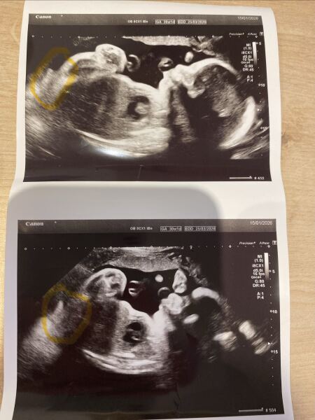 I think my growth scan may have accidentally ruined the surprise of the gender of my baby. What do you all think?