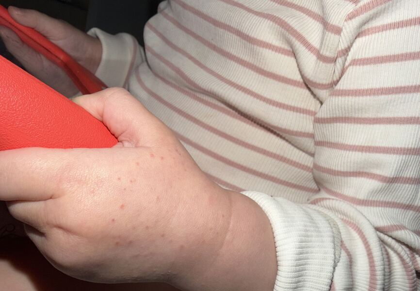 Does this look like eczema?