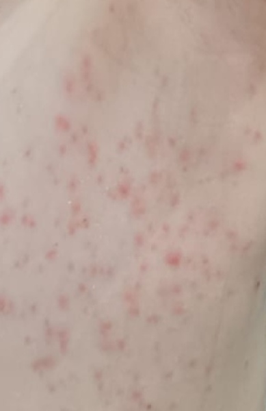 Rash days after chicken pox