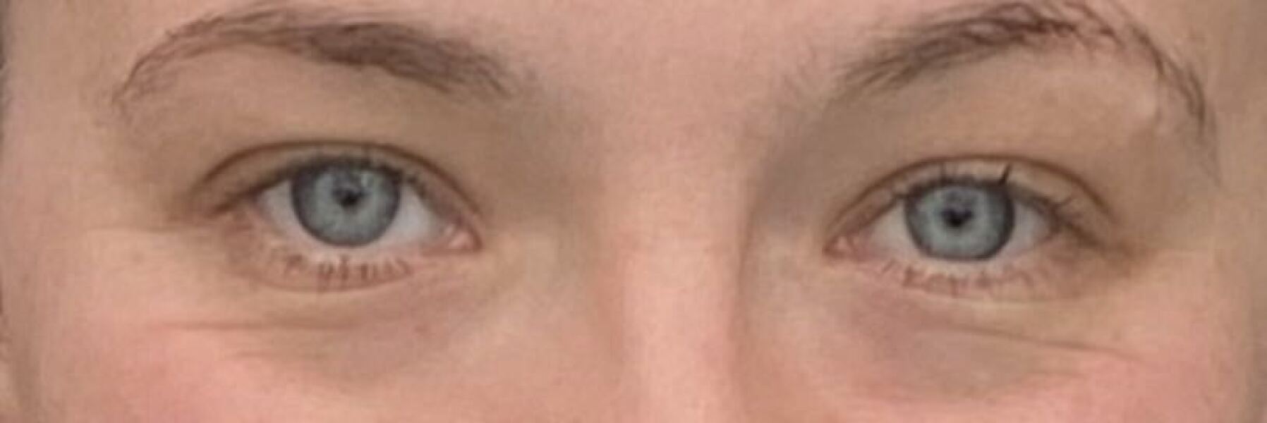 Under eye treatments