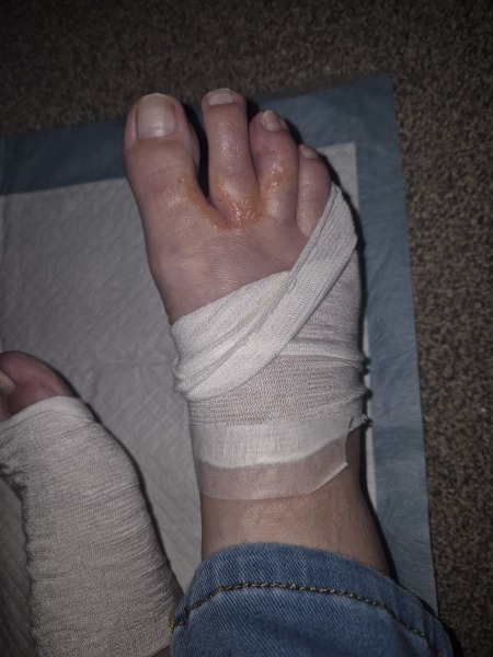Is this dyshidrotic eczema?