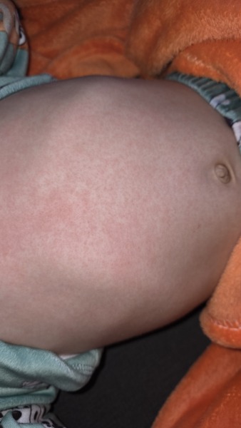 Rash on toddler