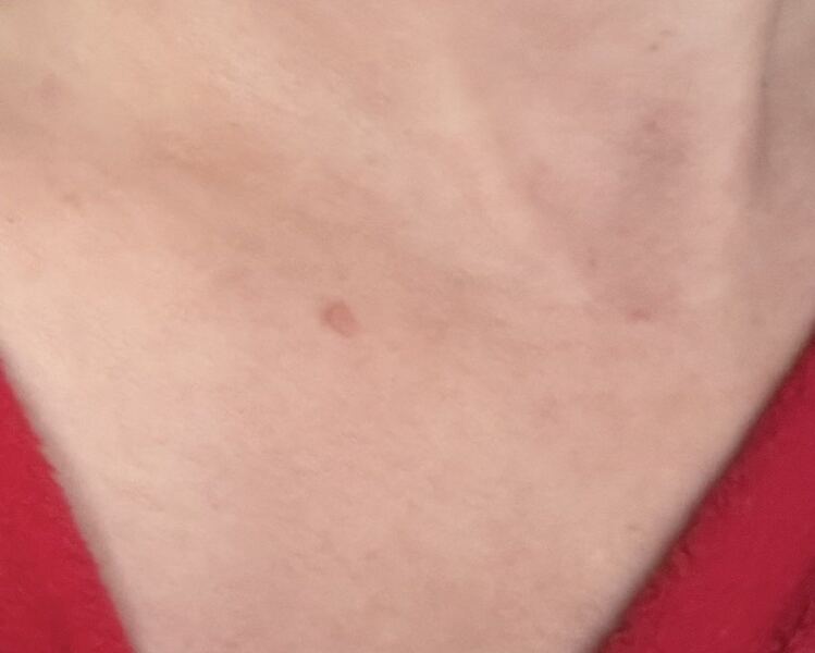 Do you think this could be a basal cell skin cancer ?