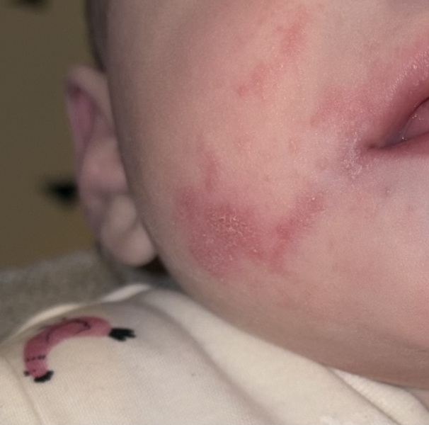 I am SO frustrated with my daughter’s skin!