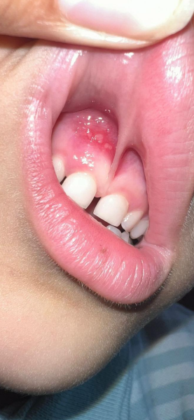 Recurrent gum ulcers in children is it normal?