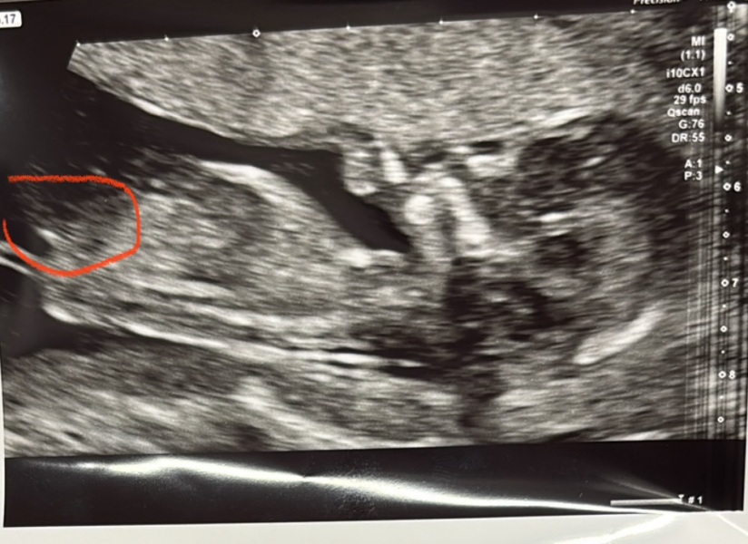 Nub Theory fun, boy or girl?