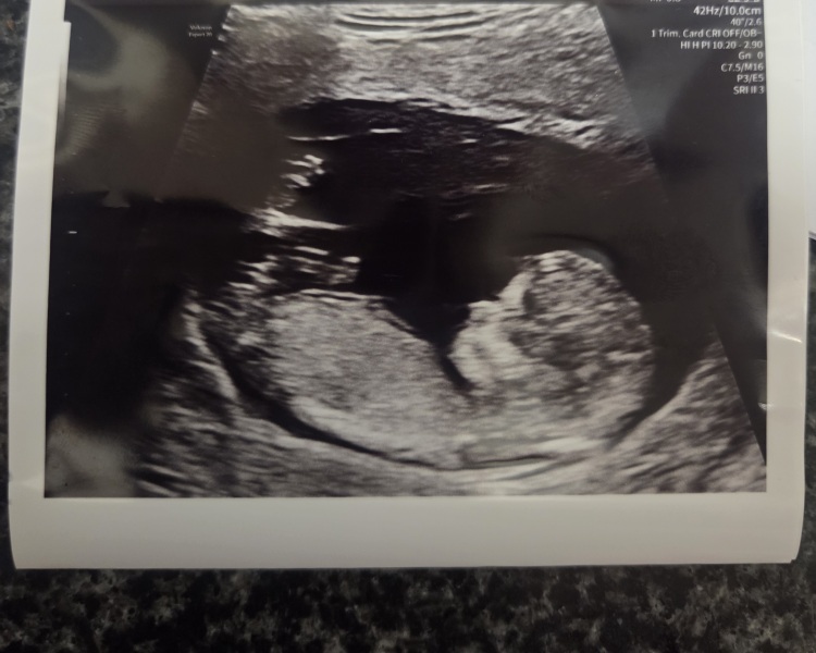 Girl or Boy? Nub theory on 12 week scan