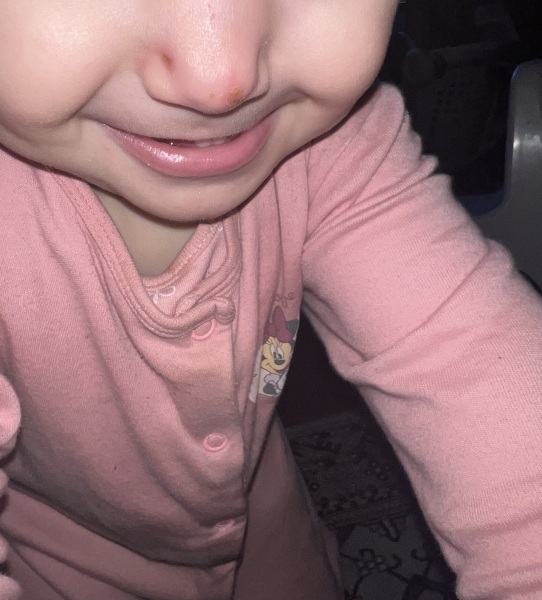 Baby nose all sudden ulcer? Scab? Wound?