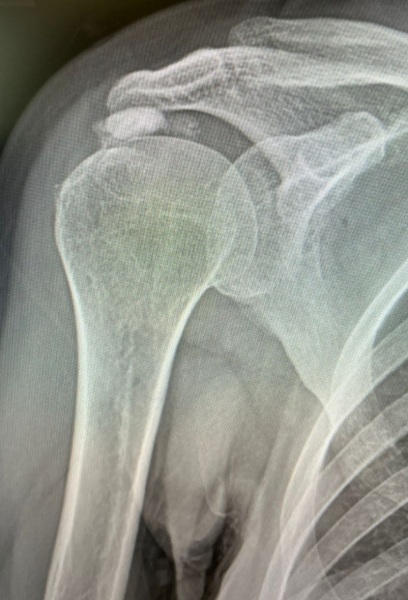 Terrible shoulder pain- calcific tendonitis