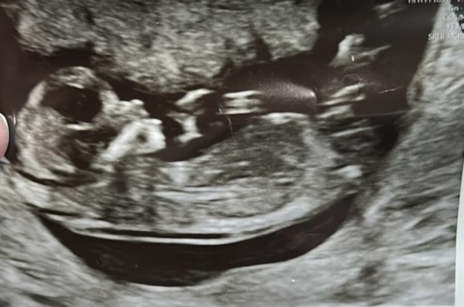 Nub theory!! Boy or girl??