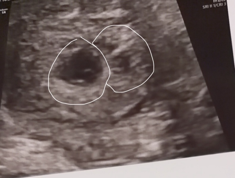 Possible twins on early scan?