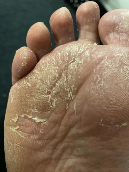 Why are my feet all peeling . Horrible pic included!