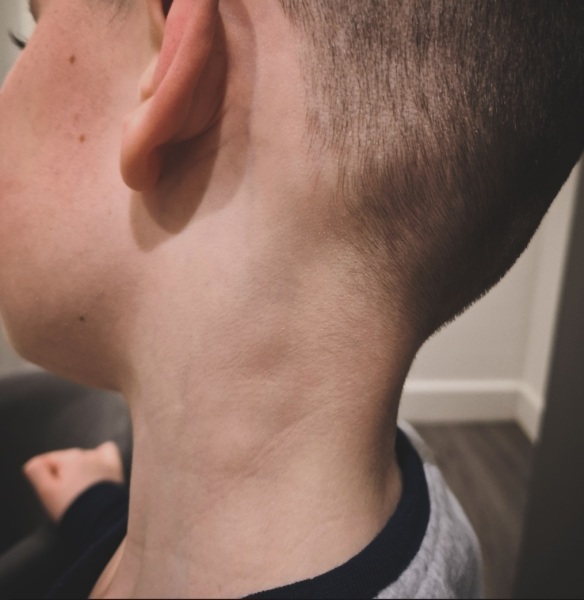 DS7 Pea Size Lump on Collarbone (pic included)