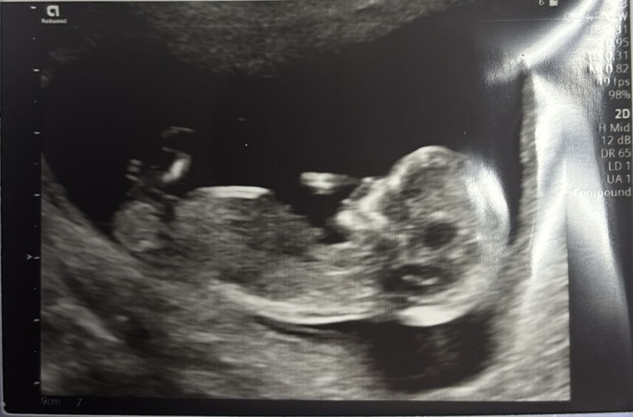 12 week scan - boy or girl?
