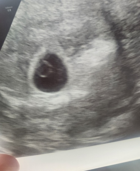 Yolk sac 5+ weeks