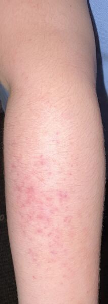 Anyone know what this is (rash)