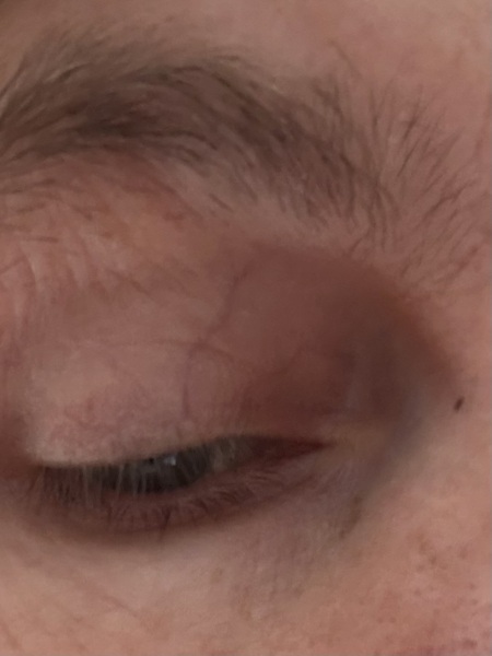 Does anyone know what might be causing this ‘bruising’ in the corner of my eye?