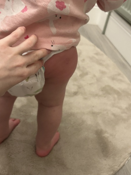 Swollen legs after vaccination