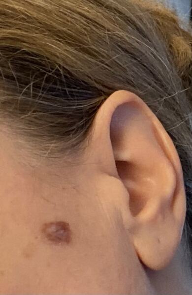 Aftercare for seborrheic keratosis removal (with photo)