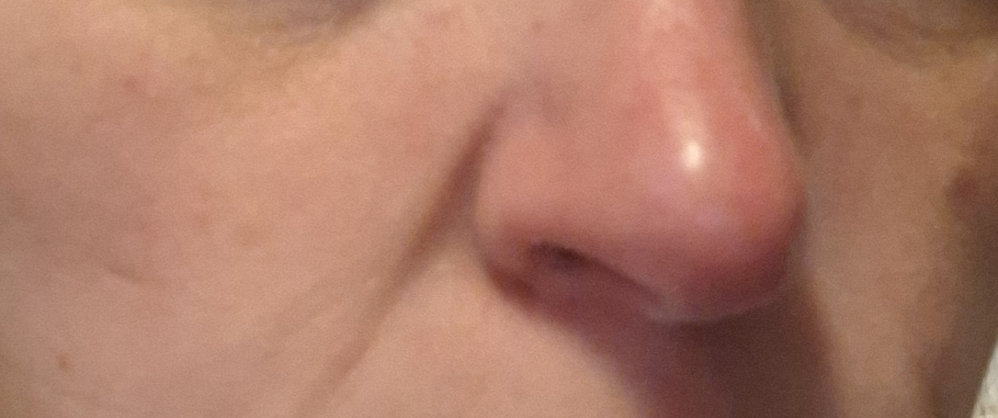 My nose is always red, is there anything I can do (can't afford lazer)