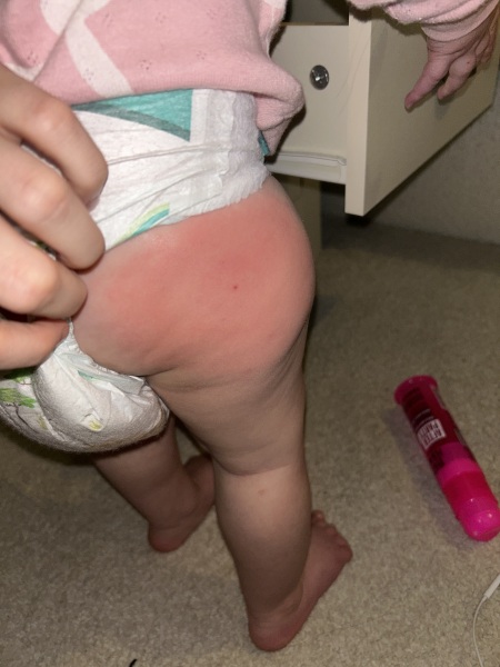 Swollen legs after vaccination