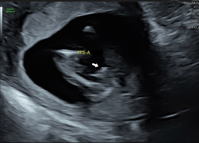 Boy or girl gender guesses 12+4