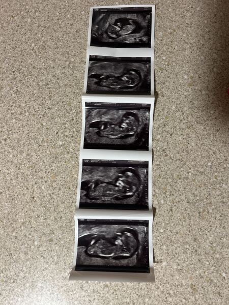 Nub theory… boy or girl?