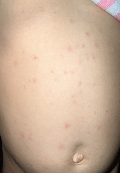Mysterious red spots on toddler