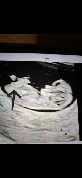 Is this the nub ?
