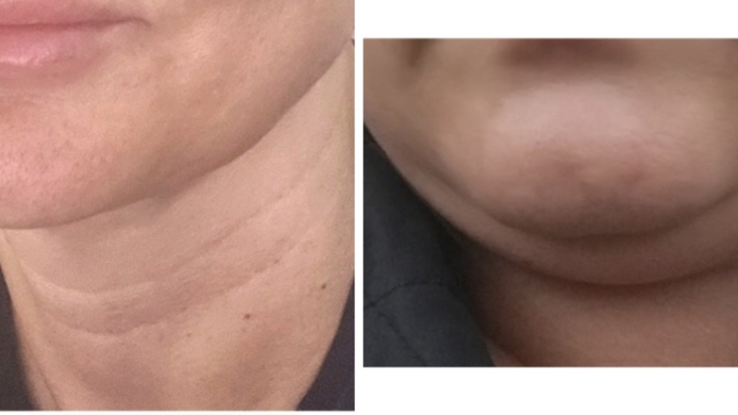 Horrendous crepey neck