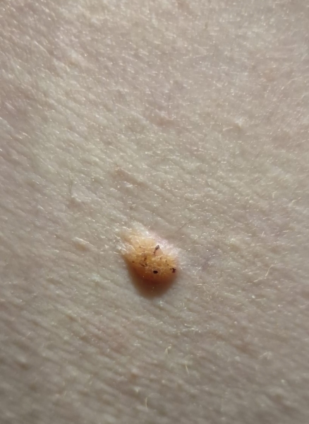 New Mole