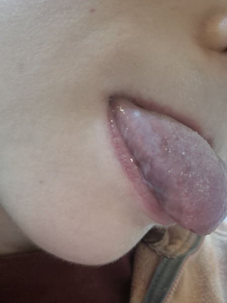 White patch on side of tongue