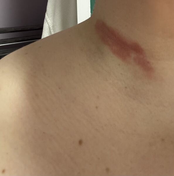 Weird Rash on Neck