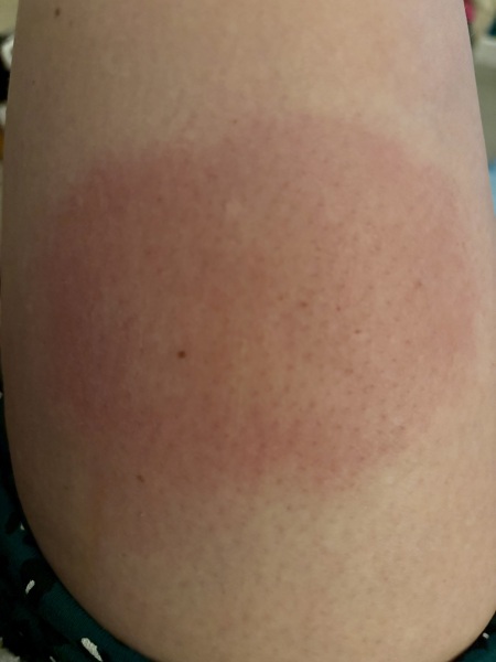 Skin reaction - should I be worried?