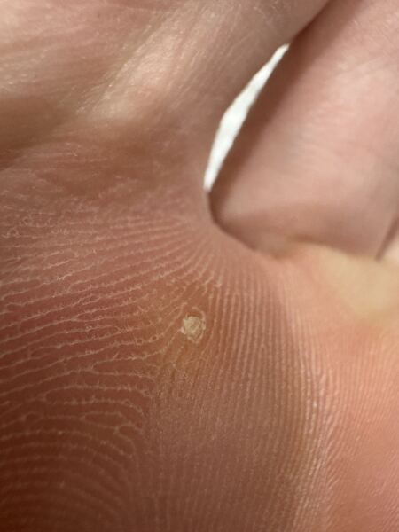 Content warning- foot (corn or verruca)