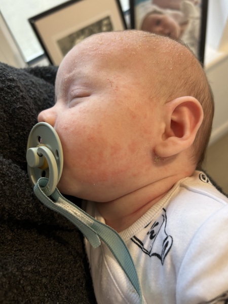 Rash that just won’t disappear, help?!