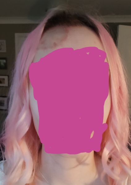 Daughter in hospital - full thickness burns