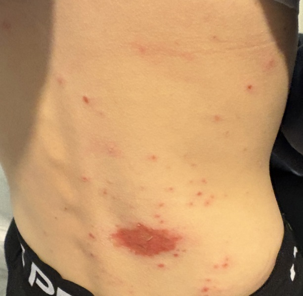 Help with rash