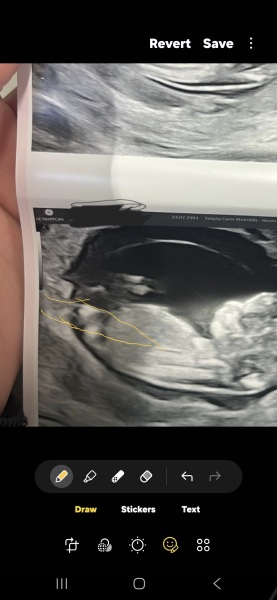 12 weeks 5 days cord or nub