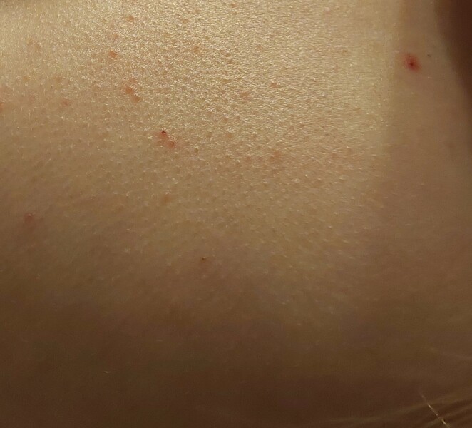 Skin rash