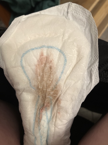 Implantation bleed [Content warning: graphic image]
