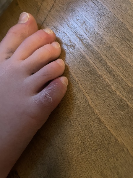 Red swollen toe ?