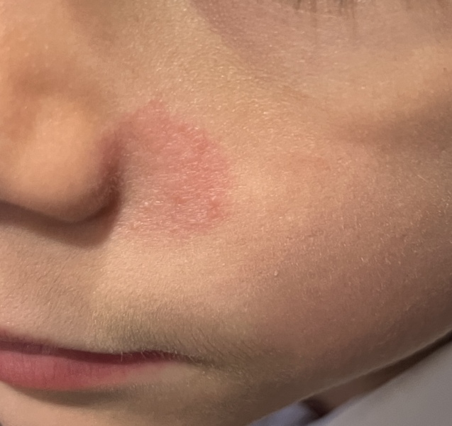 Ringworm on face help!
