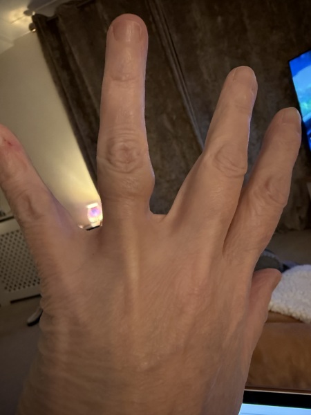 What is this lump on my finger? A ganglion?