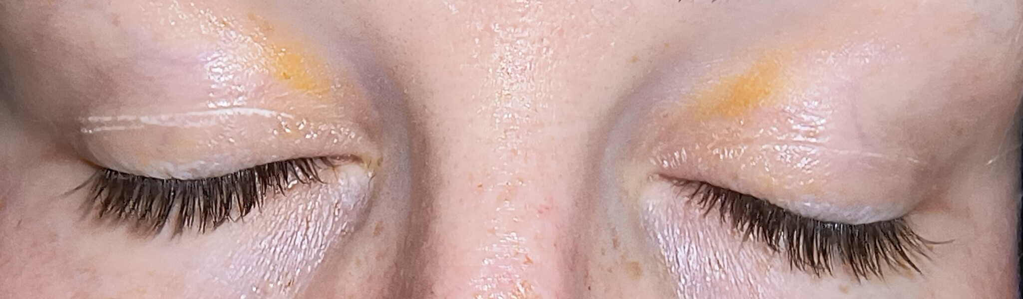 Yellow patches on eyelids