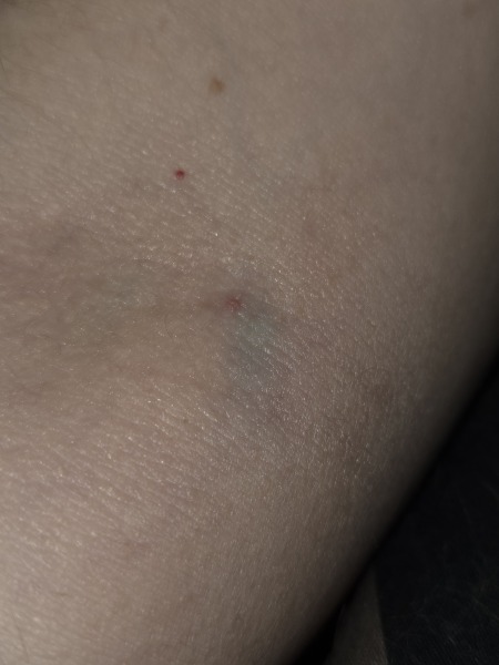 Does this look like a canula mark of a blood test one